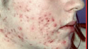 Las huellas del acné