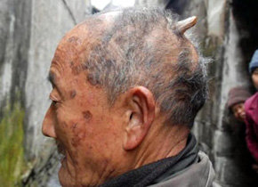 Un cuerno en la parte trasera de la cabeza le ha crecido a este hombre chino de 84 años. 

