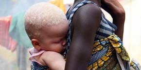 Un niño albino en algun país africano...