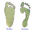 Una huella diferente: el pie plano