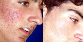 Tratamiento para el acne y las espinillas