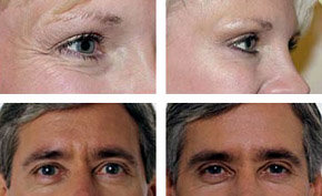 Tratamiento con toxina botulínica para eliminar las arrugas y líneas de expresión