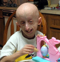 La llamada 'progeria' afecta a uno de cada 4 millones de  niños y les hace envejecer de forma acelerada 