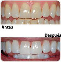 ¿En que consiste el Blanqueamiento Dental?