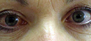 El glaucoma, un 'ladrón de la visión' que la mitad de los afectados desconoce padecer