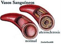 ¿Qué es la arteriosclerosis?
 