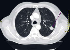  
Tecnología única para diagnóstico de cáncer pulmonar