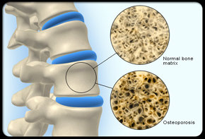 Doctor, ¿puedo tener osteoporosis?