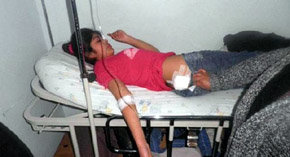 Una de las niñas herida con perdigones por la policía es atendida en el hospital de Collipulli. (Richard Curinao/comunidad mapuche Chilena) 