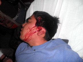 Niño mapuche herido en la cien por la policía. (Richard Curinao/comunidad mapuche Chilena) 