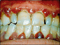 La infección de encías puede evitarse con buena higiene bucal y visitas al dentista.