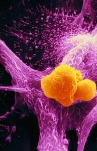 Macrófago, célula del sistema inmunitario humano, atacando una célula cancerosa.