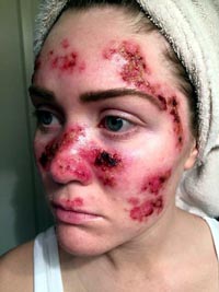 La larga exposición a los rayos UVA puede tener consecuencias devastadoras para la piel. 