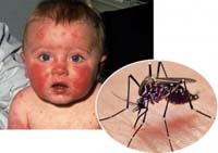 El virus del zika está relacionado con la microcefalia infantil