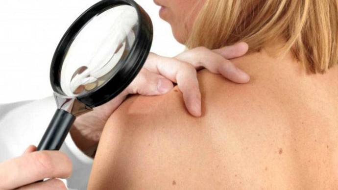 En México desarrollan un sistema no invasivo para detectar cáncer de piel