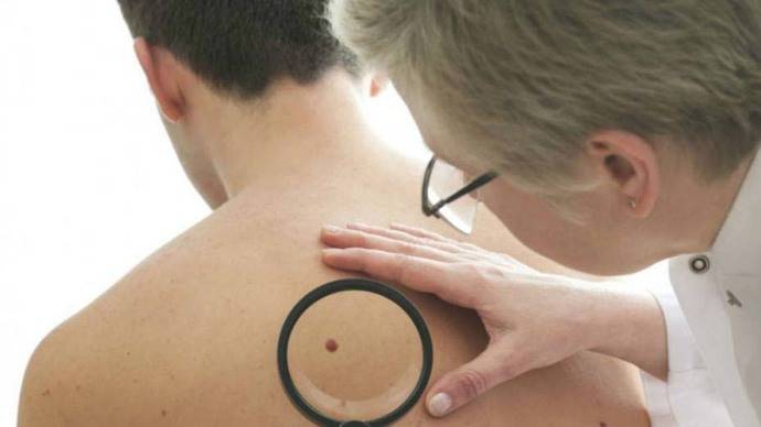 Cuba registra un nuevo medicamento contra el cáncer de piel