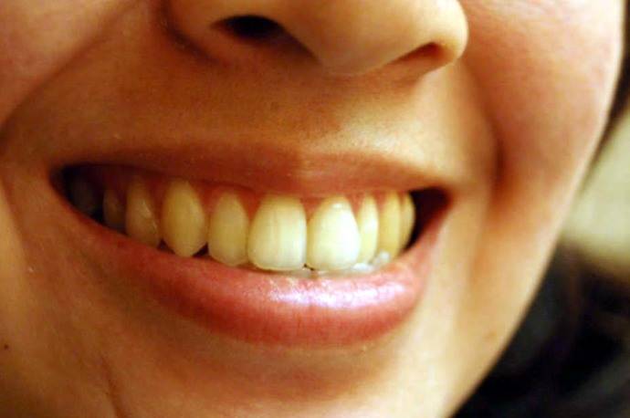 Tratamiento hormonal previene pérdida dental durante la periodontitis