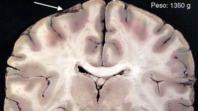 Una terapia combinada demuestra su eficiencia contra la malaria cerebral