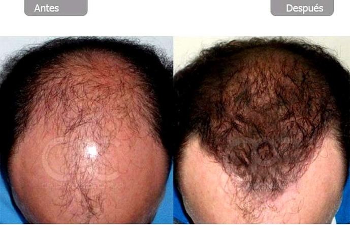 Trasplante de pelo en Turquía en paquete todo incluido