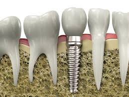 Historia y desarrollo de los implantes dentales