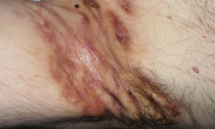 Hidradenitis supurativa, la enfermedad de la piel que por fin cuenta con diagnóstico precoz y tratamiento integral