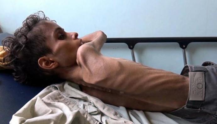 Guerra en Yemen: 85.000 niños han muerto de hambre