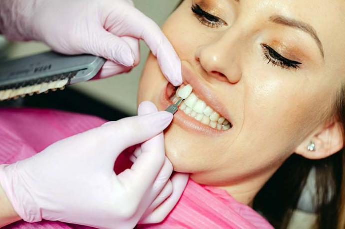 Microcarillas: la opción ideal para una sonrisa perfecta