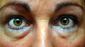 Bolsas en los ojos: Causas y soluciones para lucir una mirada fresca