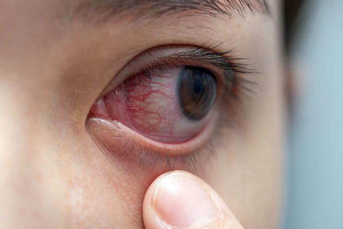 ¿Puedo meterme este verano en la piscina o en el mar con lentillas?