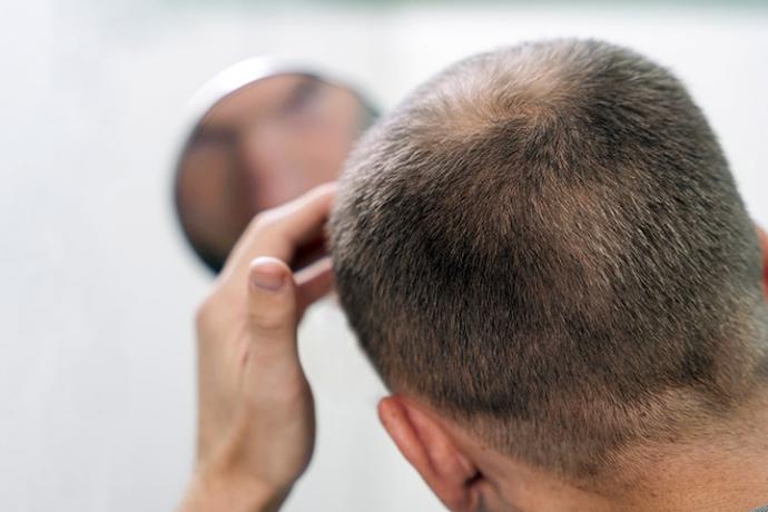 Minoxidil, el principio activo que sí frena la calvicie masculina