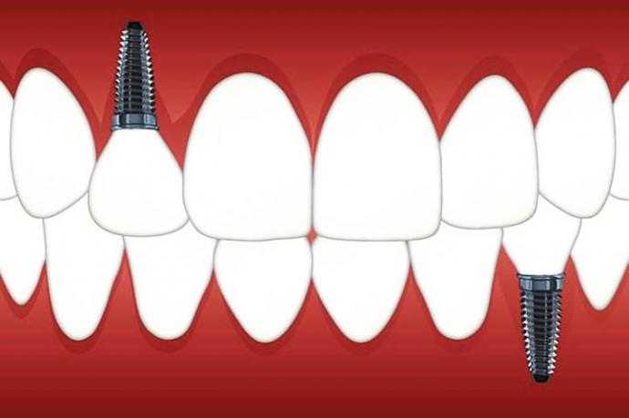 ¿En qué consiste la alineación dental?