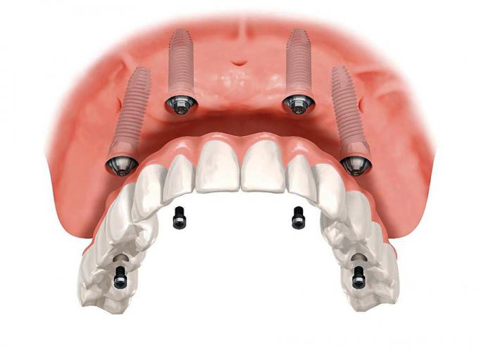 Implantes Dentales. Todo lo que necesitas saber