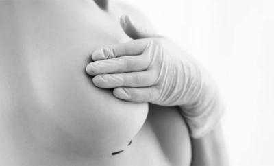 La mamoplastia apuesta por la técnica AMI