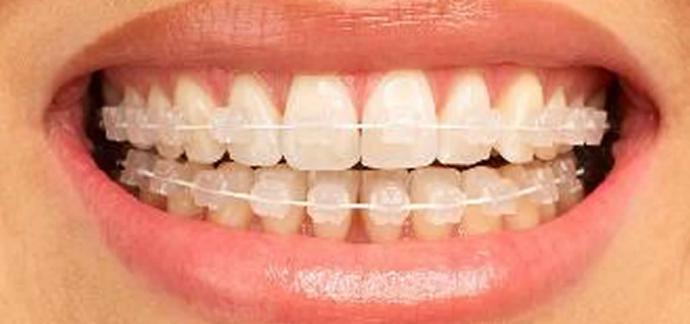 La ortodoncia invisible