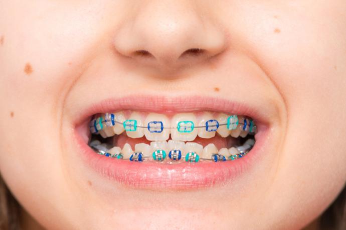 Descubre los signos que demuestran que tus hijos necesitan ortodoncia