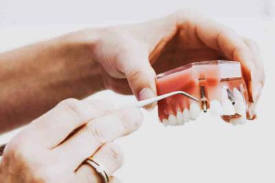 Implantes dentales en Toledo: una solución efectiva para reemplazar dientes perdidos